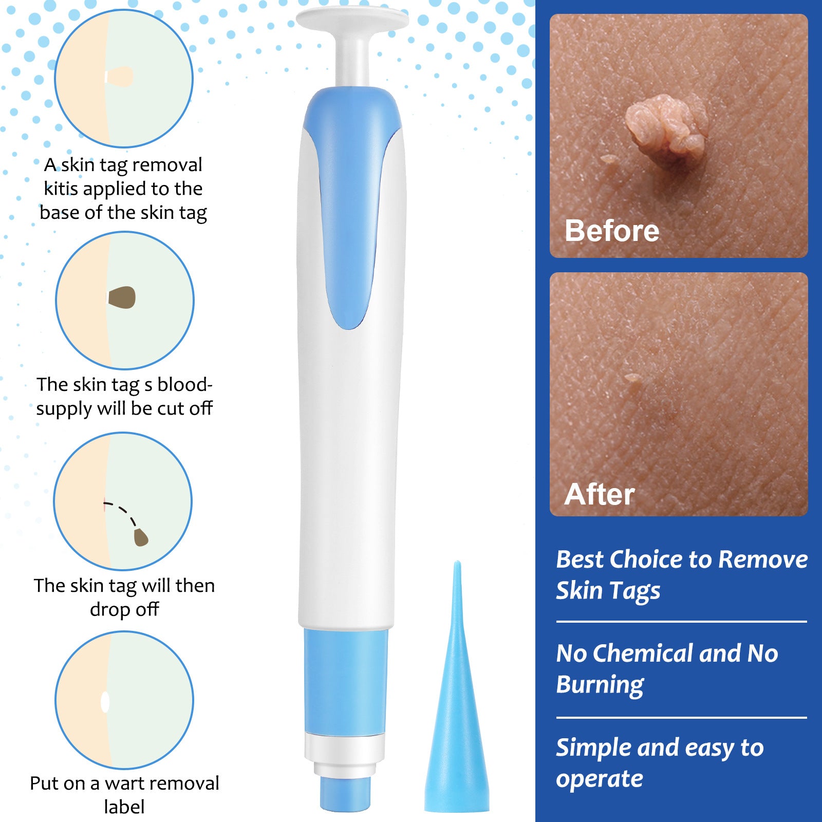 Skin Tag Removal Kit with Cleansing Swabs showing before and after results, easy application process and no chemical burning.
